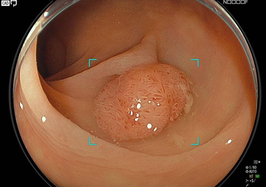 大腸ポリープ
