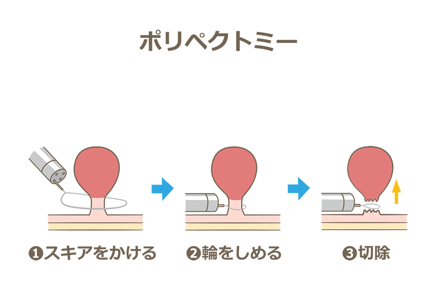 ポリペクトミー