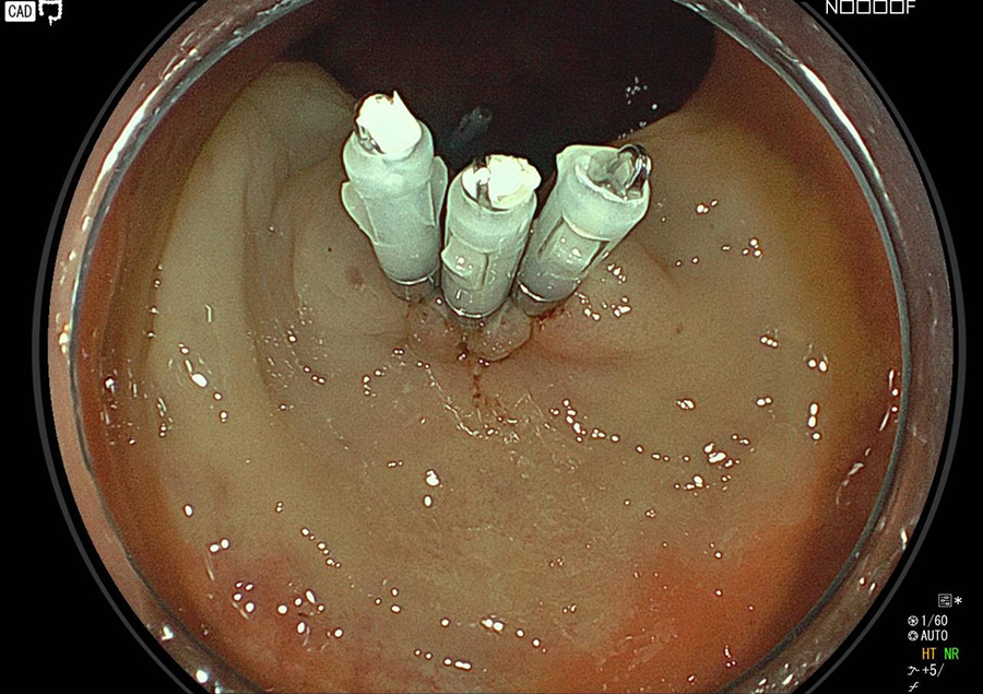 大腸内視鏡ポリープ切除術の様子