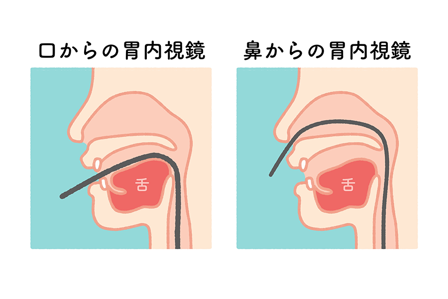 口からの胃内視鏡と鼻からの胃内視鏡の比較