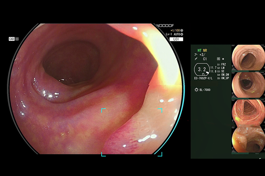 病変検出支援機能の画面