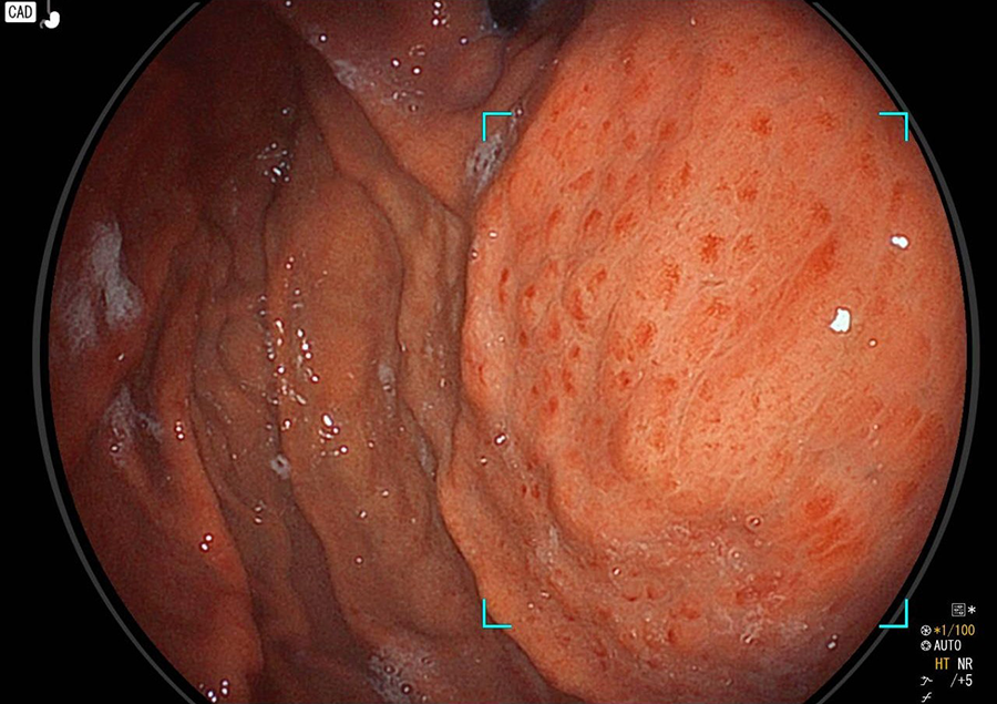 ピロリ感染胃炎