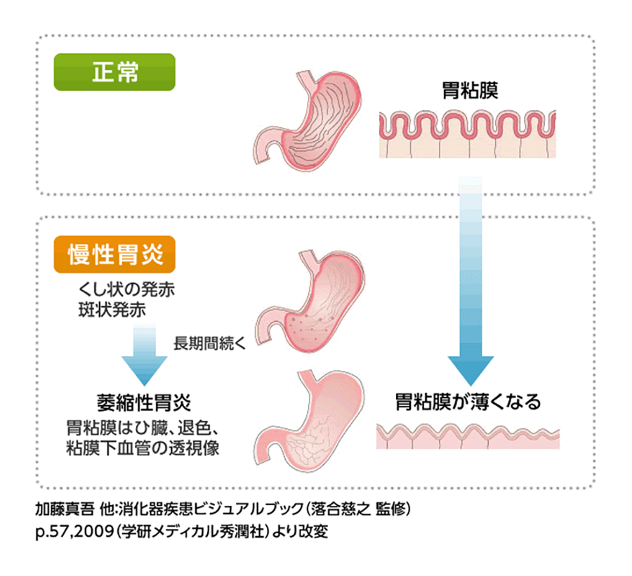 正常な胃と慢性胃炎